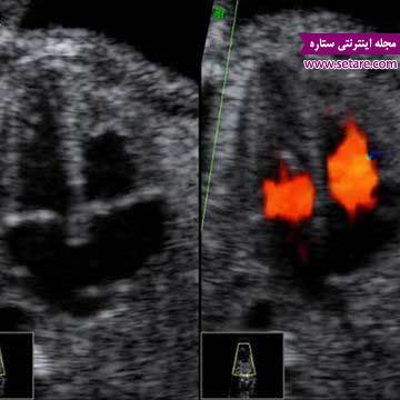 هفته به هفته باردار - هفته های بارداری - هفته بیست و چهارم بارداری